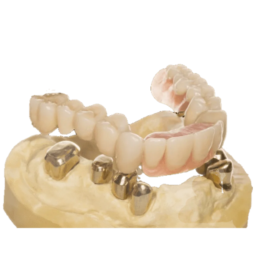 Teleskopprothese